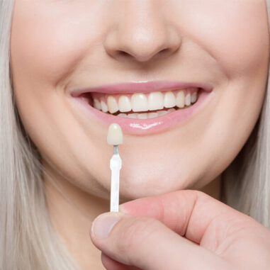 How Dental Veneers Can Improve Your Smile