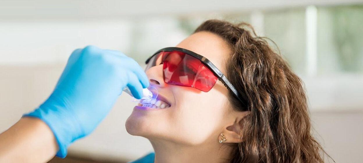 What Makes Professional Teeth Whitening So Effective?