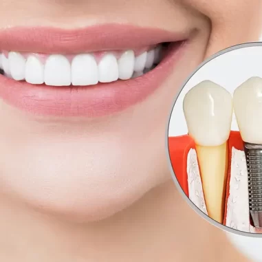 10 Dental Implant Recovery Tips for Faster Healing After Surgery